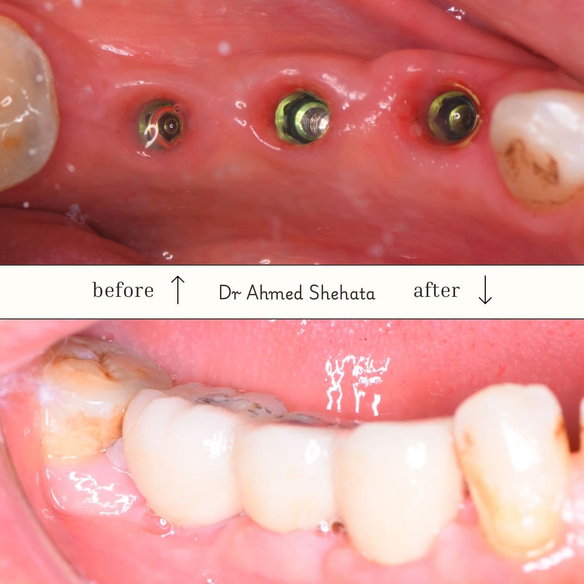Dental implant procedure - Before and After by Dr. Ahmed Shehata