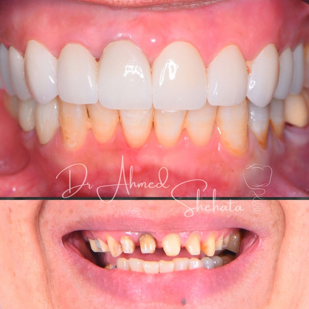 Full smile makeover - Before and After by Dr. Ahmed Shehata